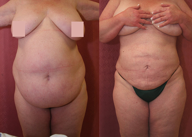 Large Volume Liposuction Before And After Los Angeles