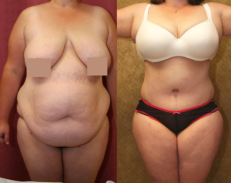 Plus Size Tummy Tuck Before And After Los Angeles