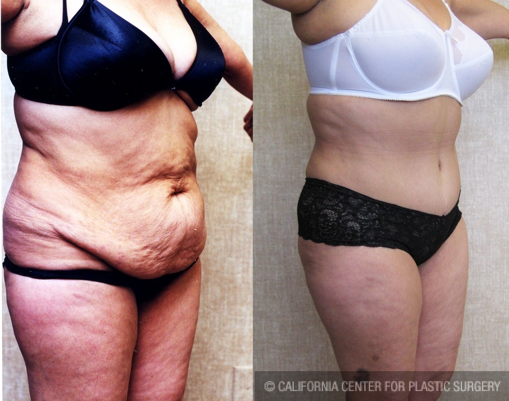 Tummy Tuck Before & After Photos of Patient at The Center for