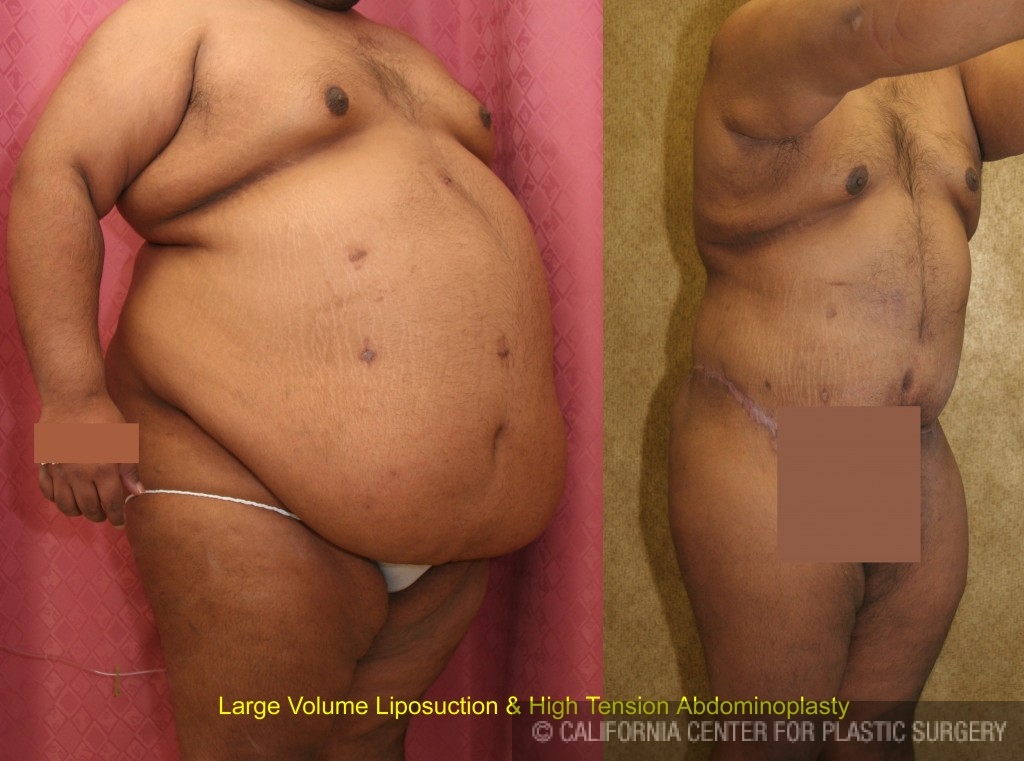 Male Liposuction Abdomen Before & After Patient #5617