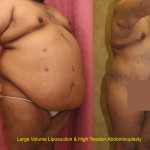 Male Tummy Tuck (abdominoplasty) Before & After Patient #6031