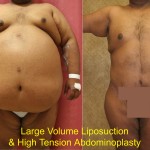 Male Liposuction Abdomen Before & After Patient #5617