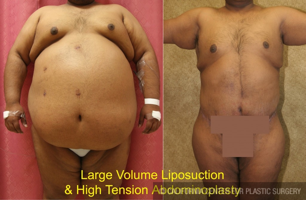 Tummy Tuck and Liposuction on Male Weight Loss Patient