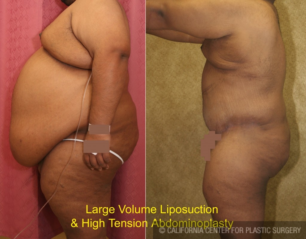 Male Liposuction Abdomen Before & After Patient #5617