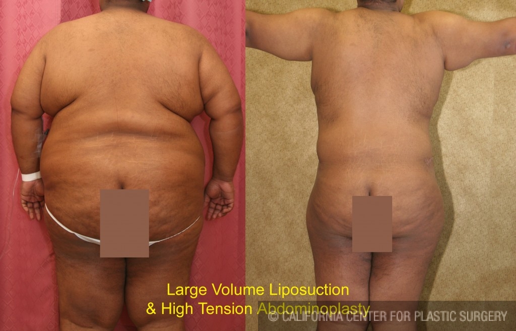 Male Liposuction Abdomen Before & After Patient #5617