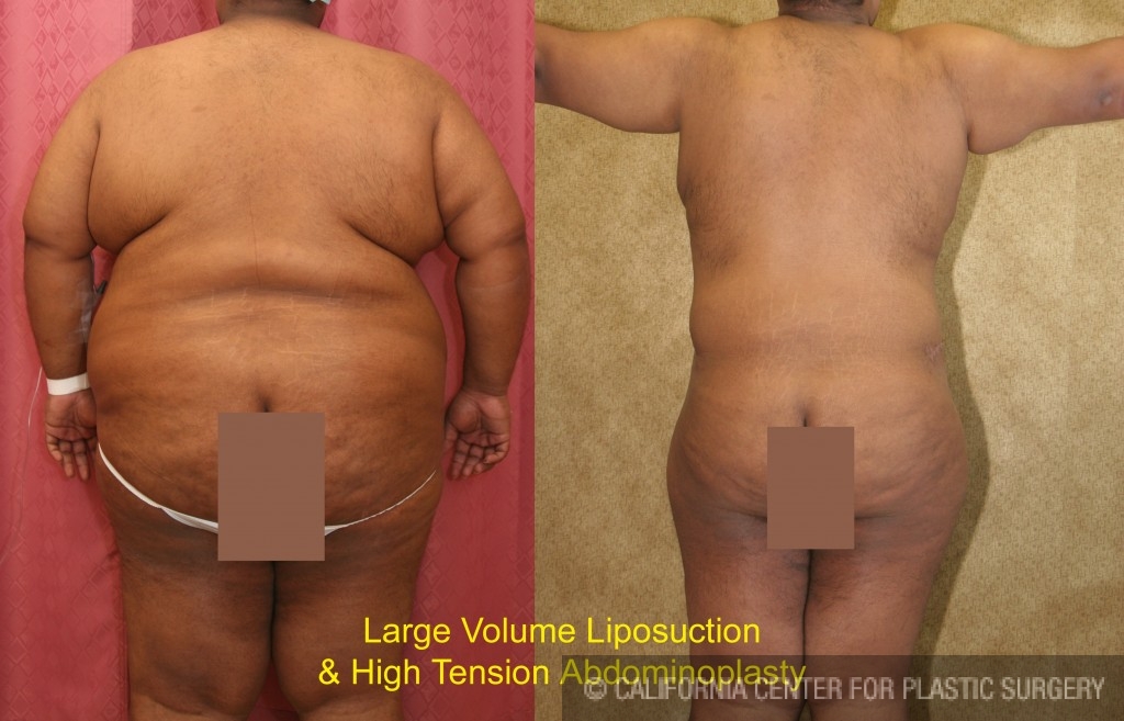 Patient #6031 Male Tummy Tuck (abdominoplasty) Before and After Photos  Beverly Hills - Plastic Surgery Gallery Los Angeles, CA - Dr. Sean Younai