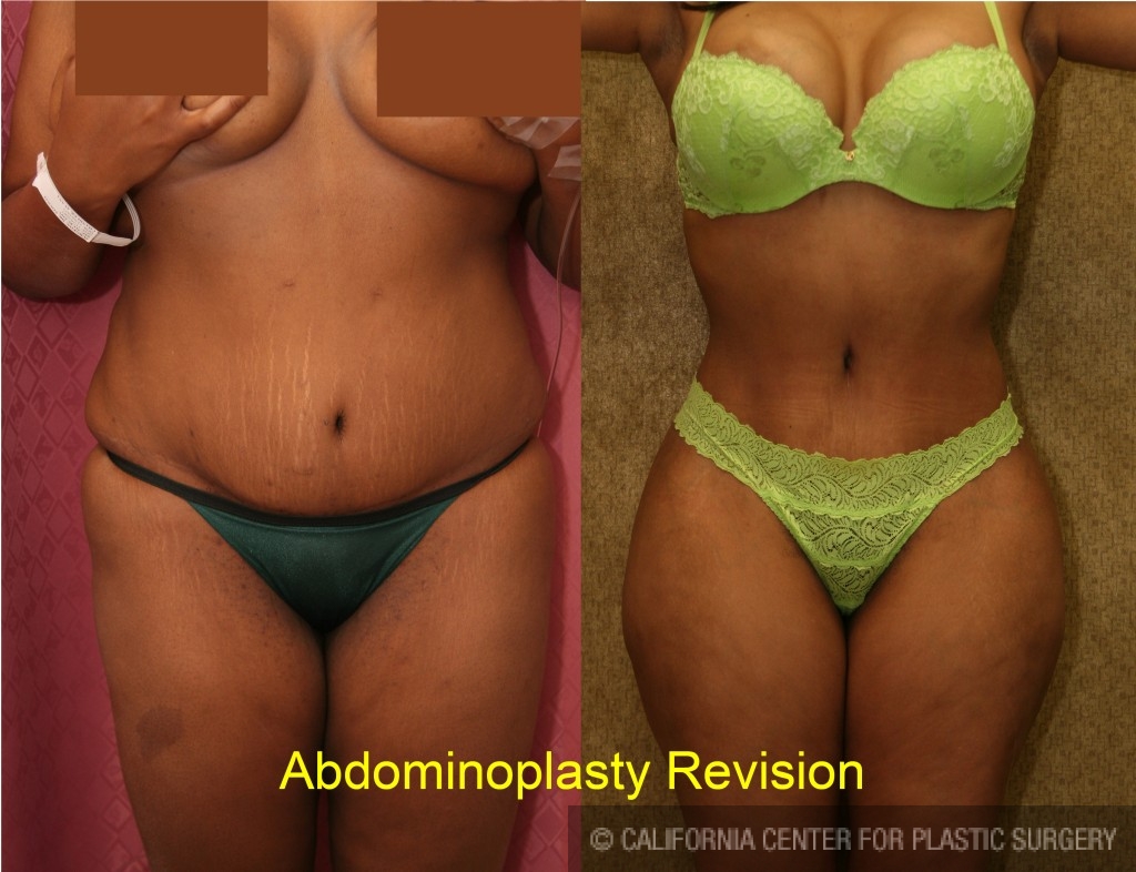 Tummy Tuck Revision Surgery Before and After