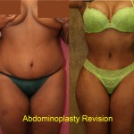 African American Tummy Tuck (Abdominoplasty) Before & After Patient #5919