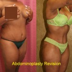 Tummy Tuck (Abdominoplasty) Medium Size Before & After Patient #5760