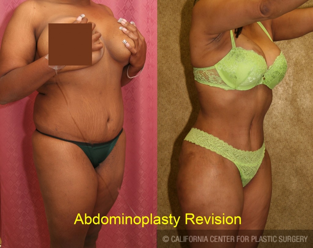 Patient #5760 Tummy Tuck (Abdominoplasty) Medium Size Before and After  Photos Beverly Hills - Plastic Surgery Gallery Los Angeles, CA - Dr. Sean  Younai