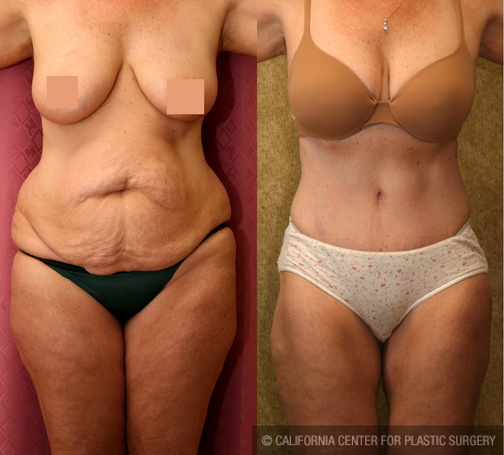 Tummy Tuck (Abdominoplasty), Woman - Age 40 - Before & After Photos