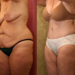 Tummy Tuck (Abdominoplasty) Medium Size Before & After Patient #5821