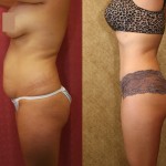 Tummy Tuck (Abdominoplasty) Small Size Before & After Patient #5726