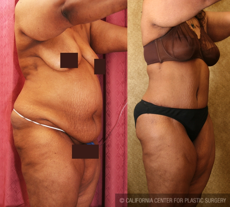 African American Tummy Tuck (Abdominoplasty) Before & After Patient #5944