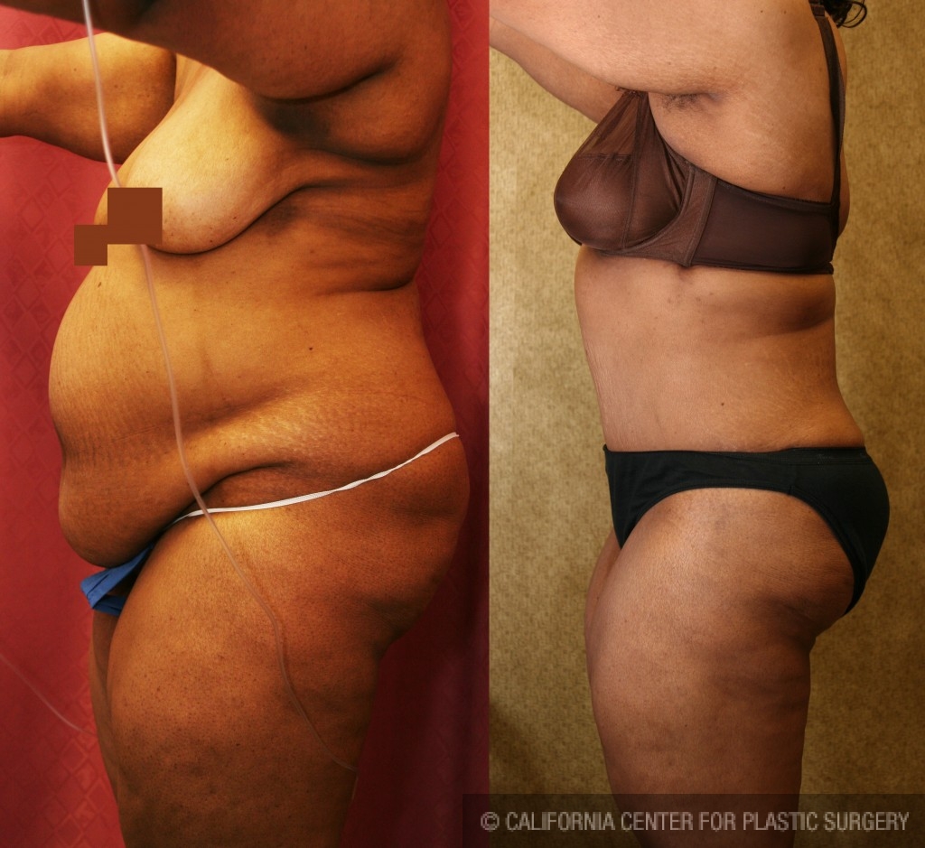 African American Tummy Tuck (Abdominoplasty) Before & After Patient #5944