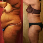 African American Tummy Tuck (Abdominoplasty) Before & After Patient #5944