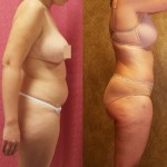 Tummy Tuck (Abdominoplasty) Medium Size Before & After Patient #5859