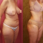 Tummy Tuck (Abdominoplasty) Medium Size Before & After Patient #5859