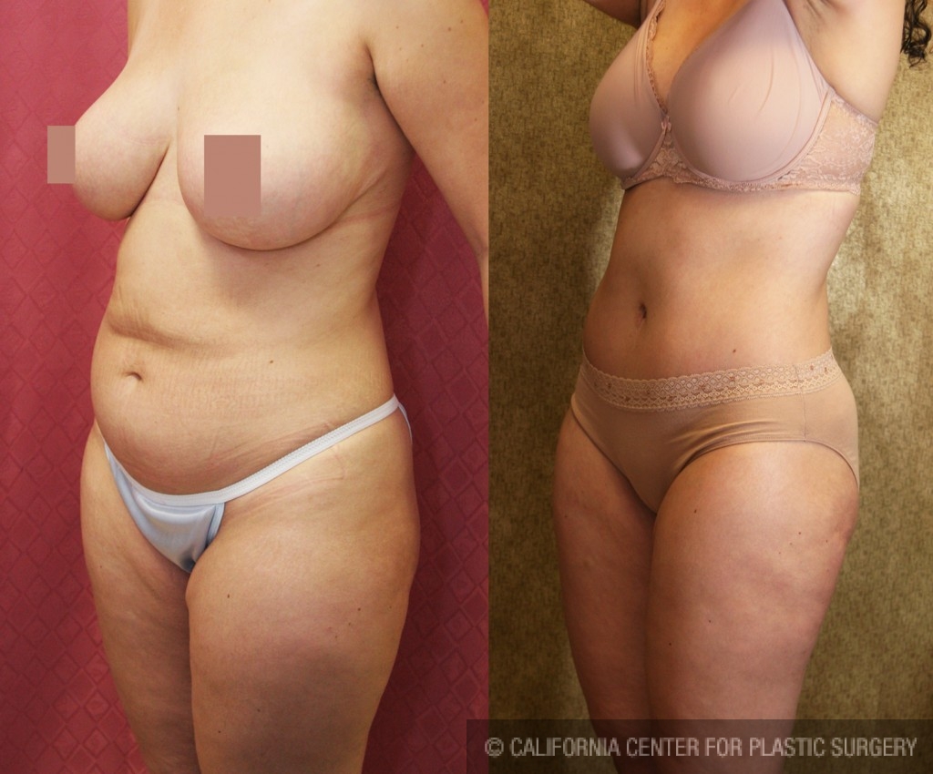 Tummy Tuck (Abdominoplasty) Medium Size Before & After Patient #5859