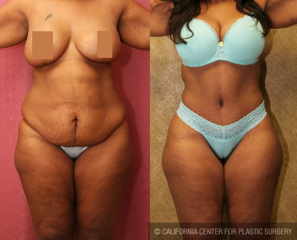 African American Tummy Tuck (Abdominoplasty) Before & After Patient #5924