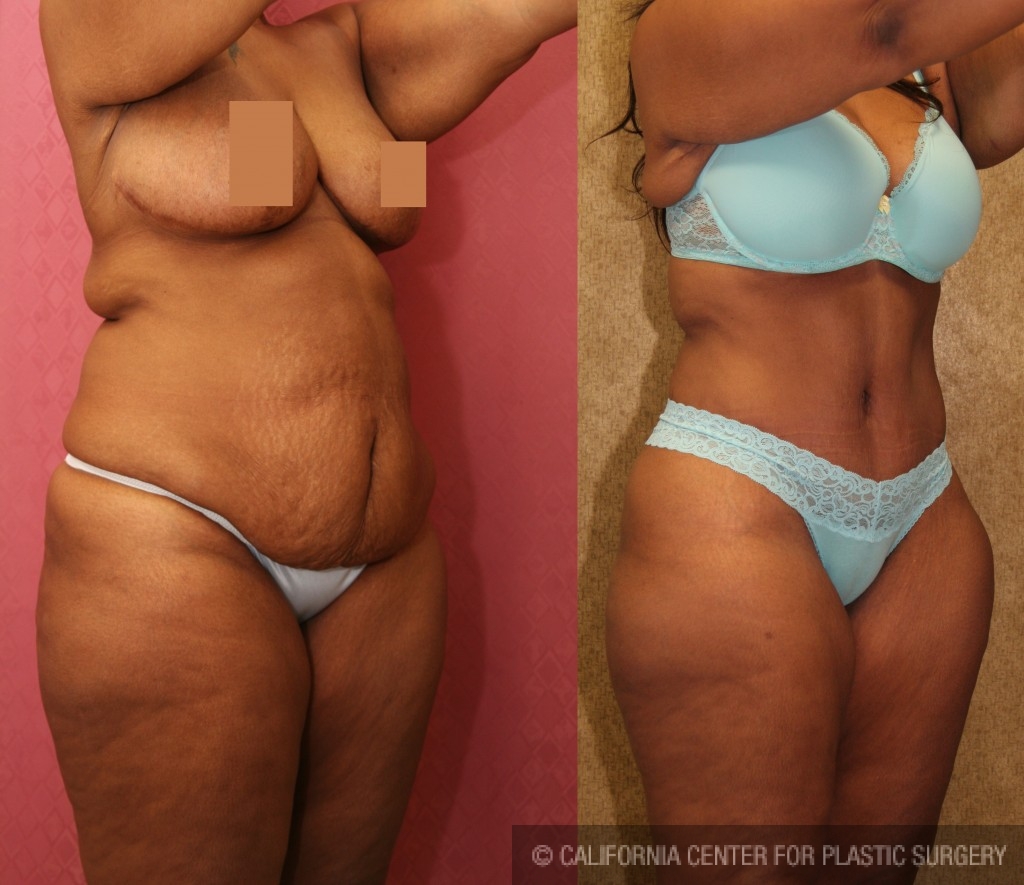 African American Tummy Tuck (Abdominoplasty) Before & After Patient #5924