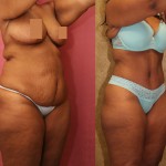 African American Tummy Tuck (Abdominoplasty) Before & After Patient #5924