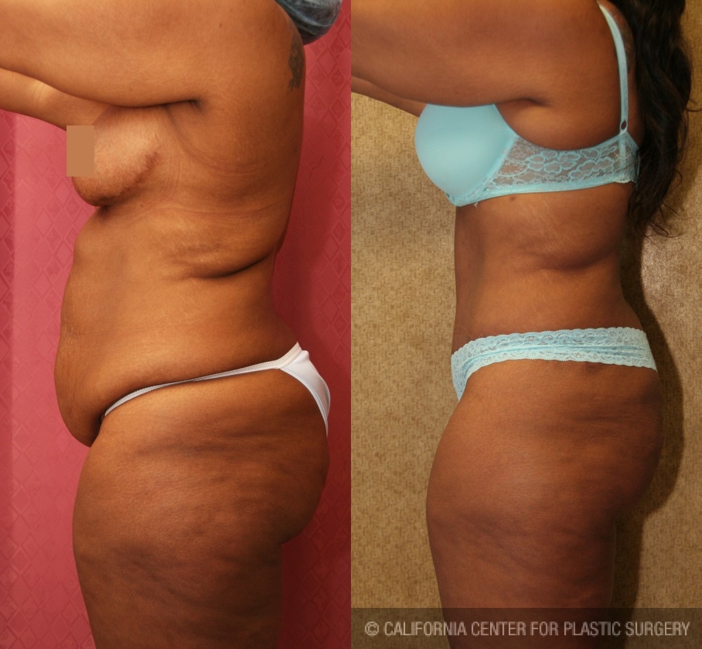 African American Tummy Tuck (Abdominoplasty) Before & After Patient #5924