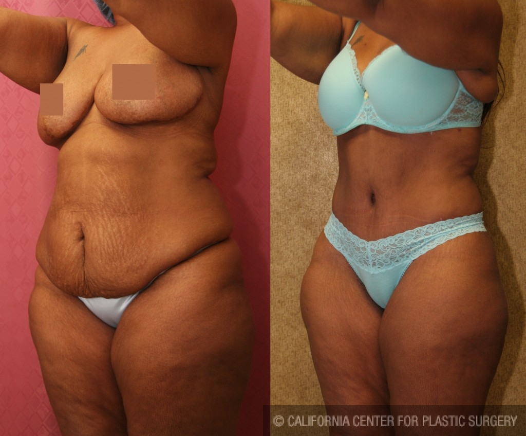 African American Tummy Tuck (Abdominoplasty) Before & After Patient #5924