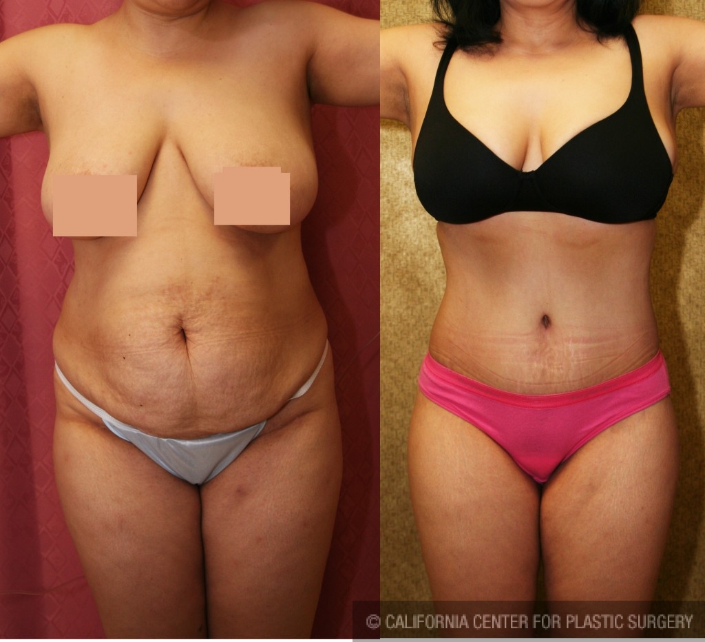 Tummy Tuck (Abdominoplasty) Medium Size Before & After Patient #5777