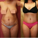 Tummy Tuck (Abdominoplasty) Medium Size Before & After Patient #5777