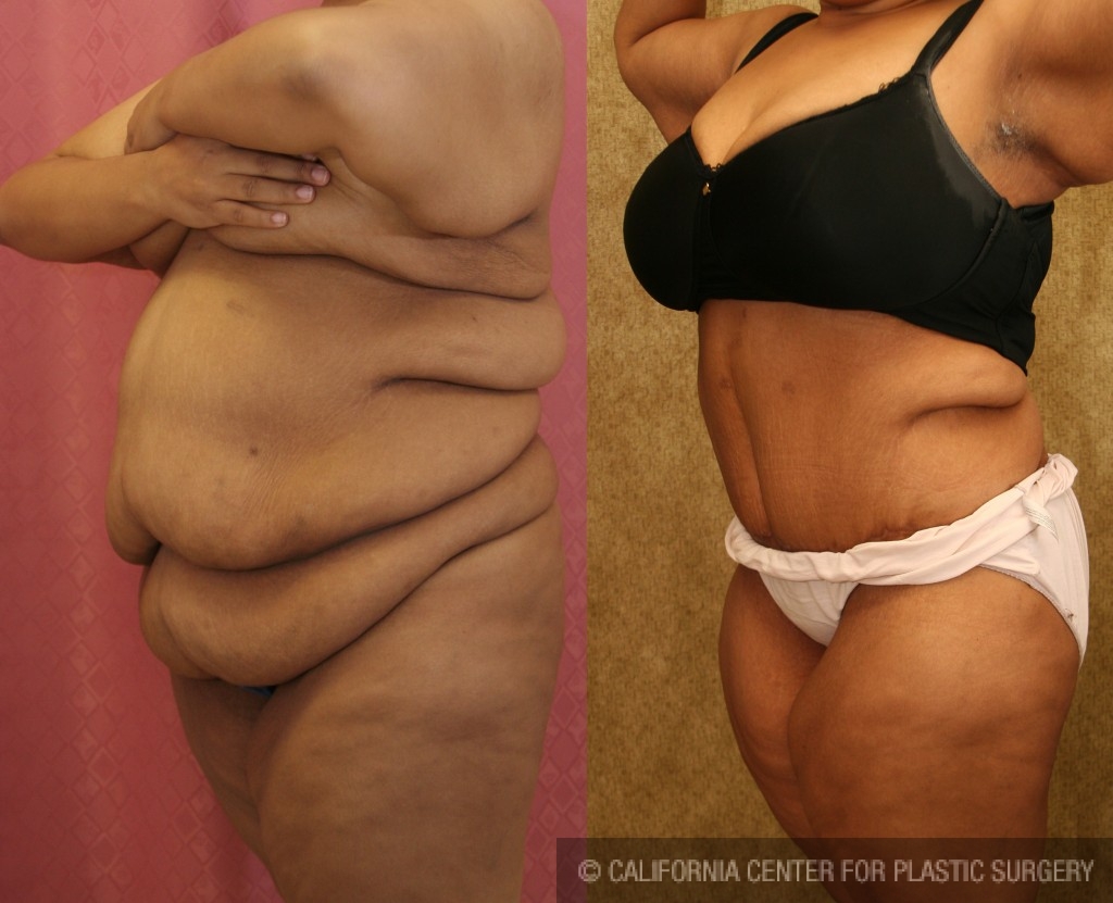 Tummy Tuck (Abdominoplasty) Plus Size Before & After Patient #5880