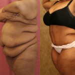 Tummy Tuck (Abdominoplasty) Plus Size Before & After Patient #5880