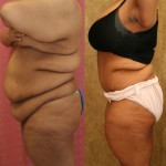 Tummy Tuck (Abdominoplasty) Plus Size Before & After Patient #5880