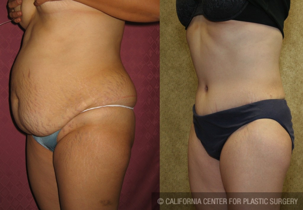 Tummy Tuck (Abdominoplasty) Medium Size Before & After Patient #5869