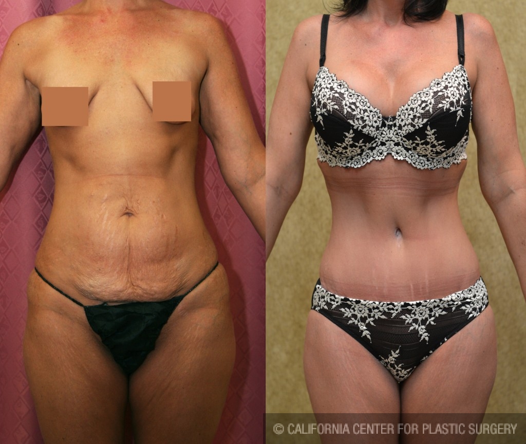 Tummy Tuck (Abdominoplasty) Small Size Before & After Patient #5732