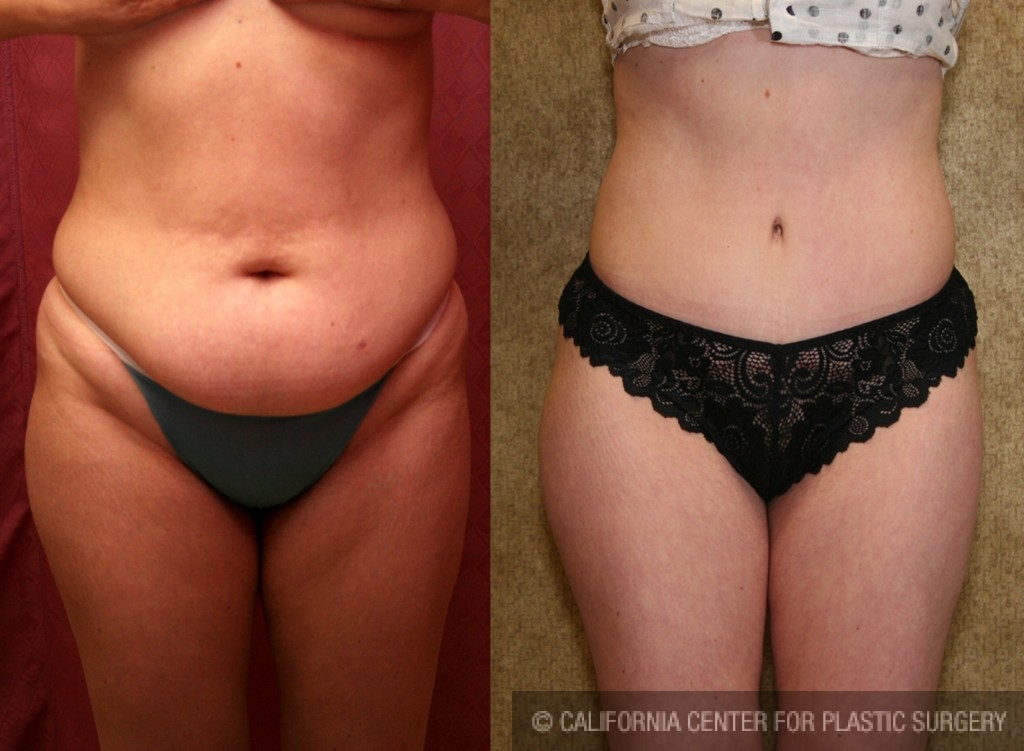 Tummy Tuck (Abdominoplasty) Small Size Before & After Patient #5737