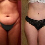 Tummy Tuck (Abdominoplasty) Small Size Before & After Patient #5737