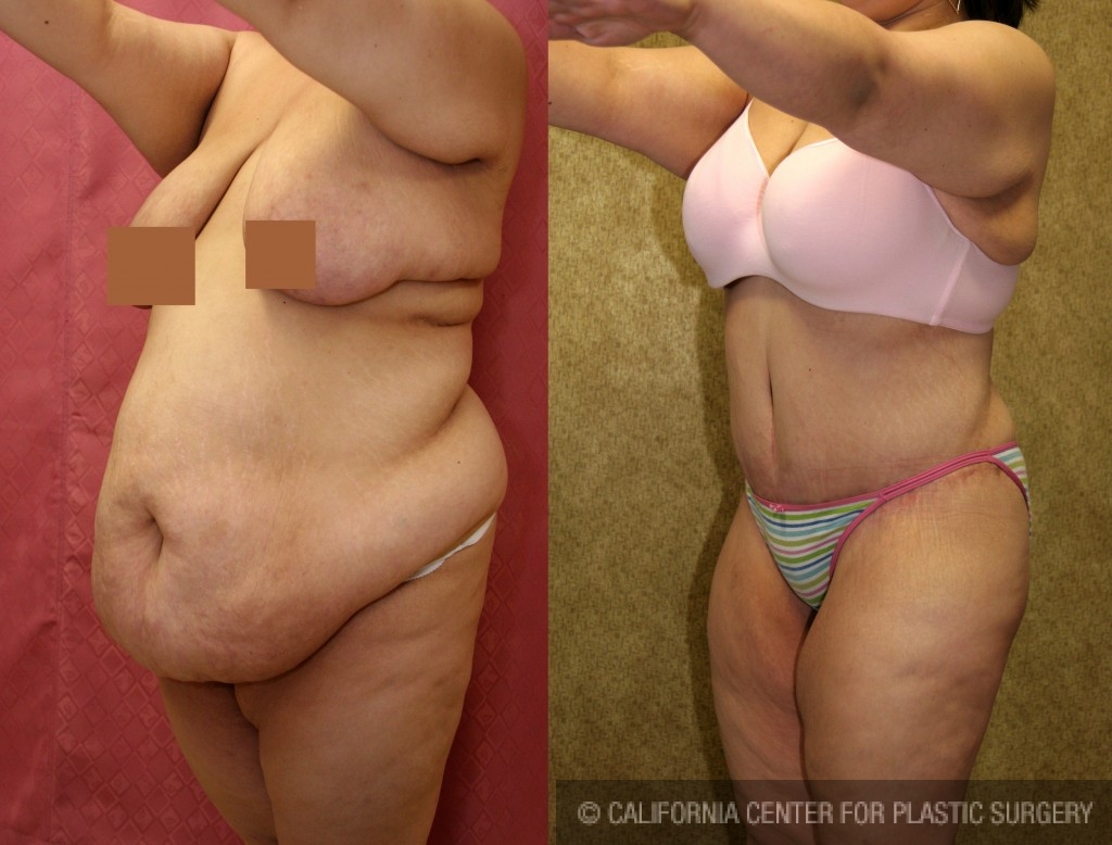 Tummy Tuck (Abdominoplasty) Plus Size Before & After Patient #5874