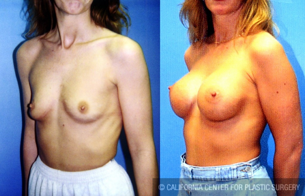 Breast Augmentation Before & After Patient #6415