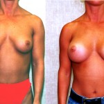 Breast Augmentation Before & After Patient #6271
