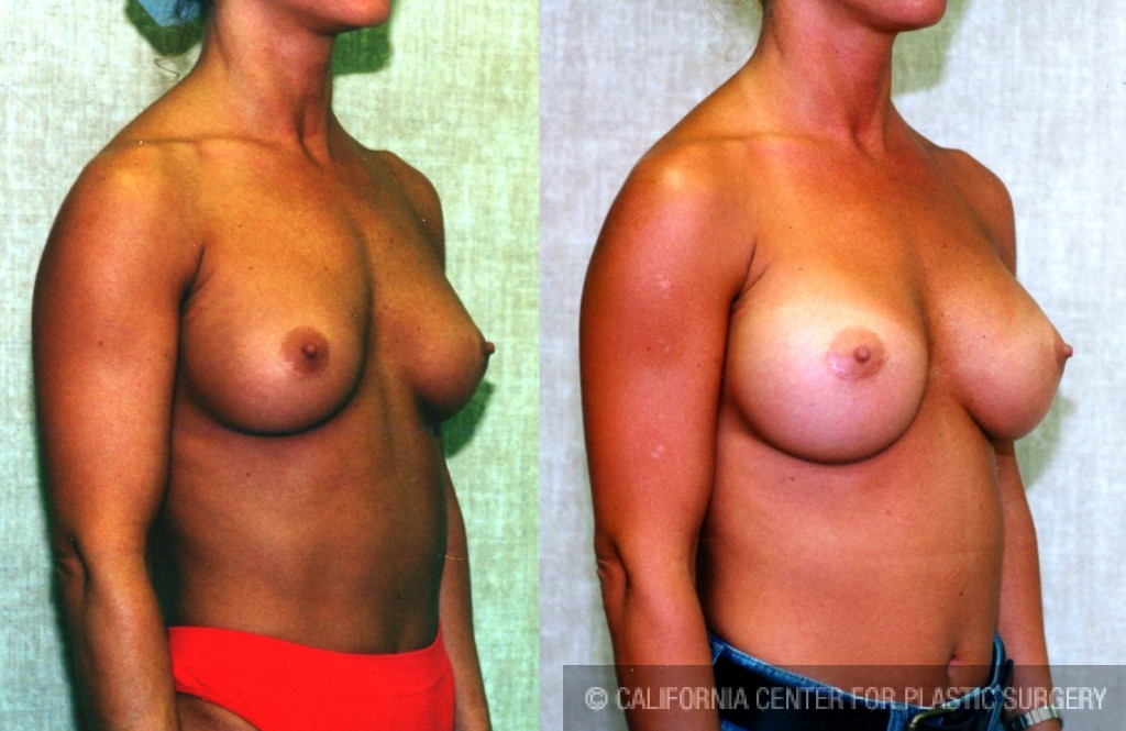 Breast Augmentation Before & After Patient #6271