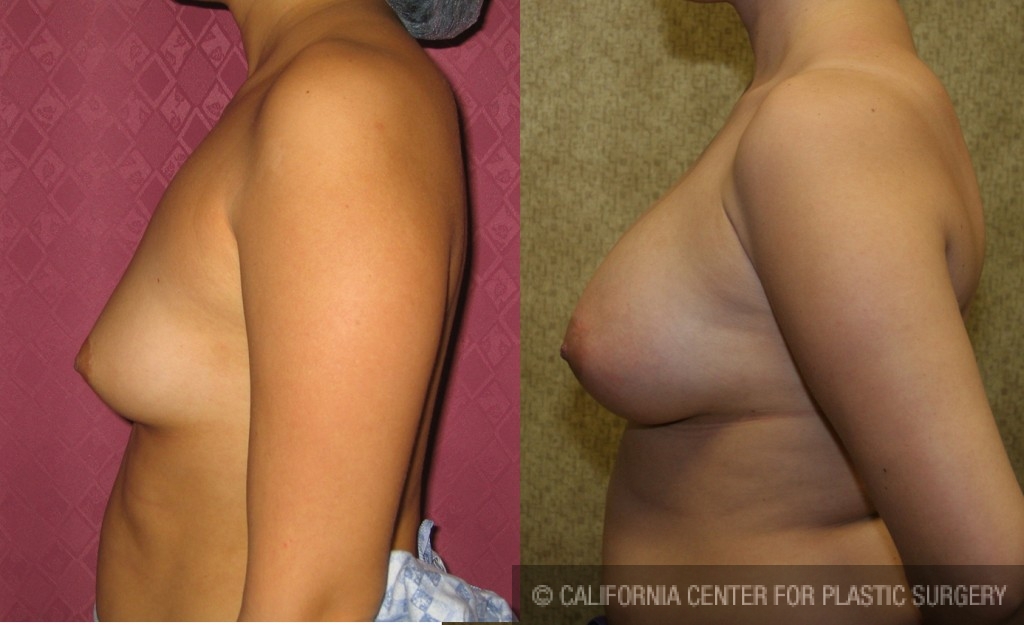 Breast Augmentation Before & After Patient #6425