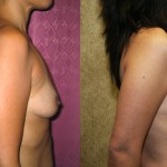 Breast Augmentation Before & After Patient #6256