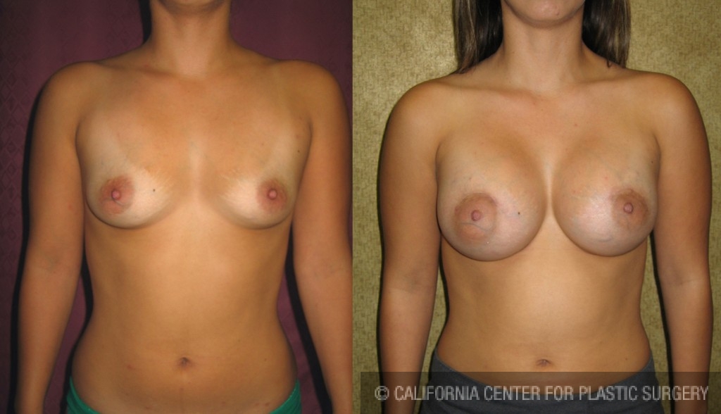 Breast Augmentation Before & After Patient #6276