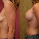 Breast Augmentation Before & After Patient #6318