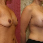 Breast Augmentation Before & After Patient #6448