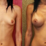 Breast Augmentation Before & After Patient #6308