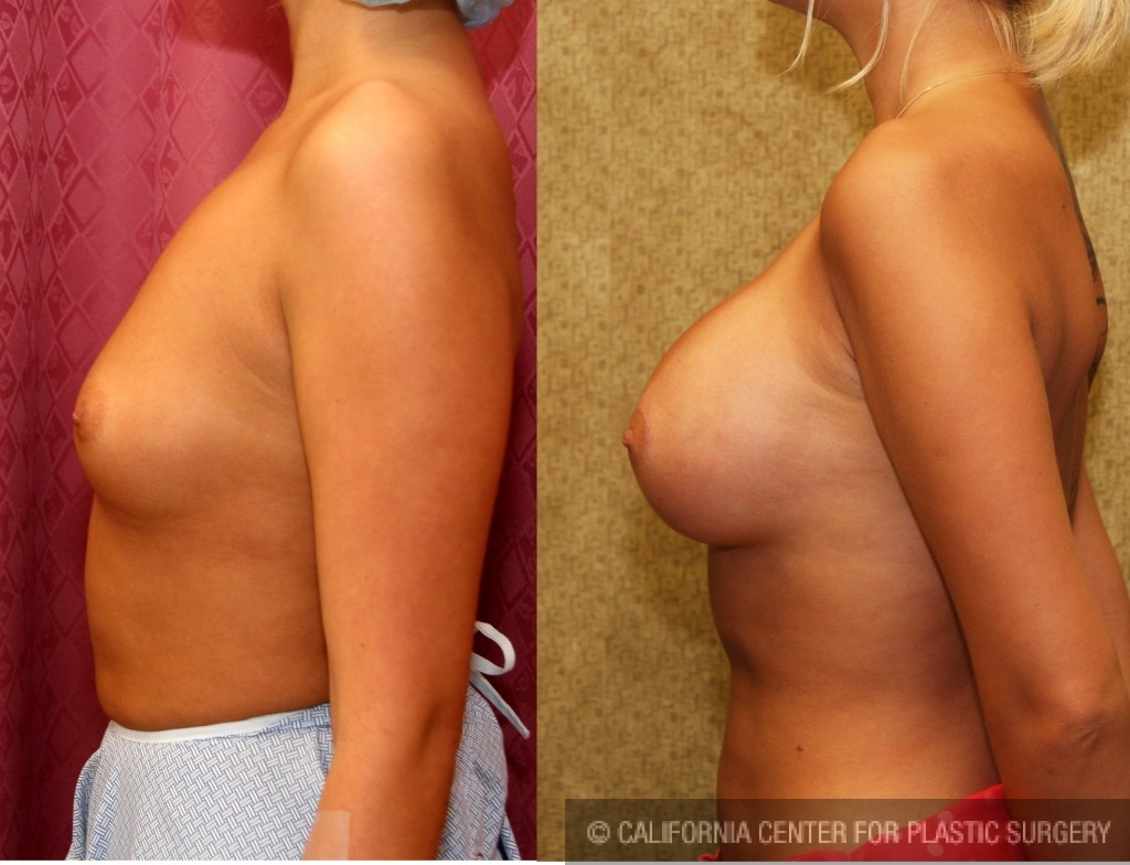 Breast Augmentation Before & After Patient #6242