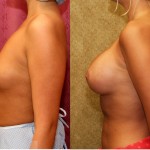 Breast Augmentation Before & After Patient #6242