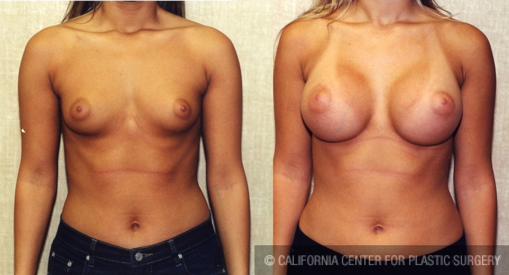 Breast Augmentation Before & After Patient #6285